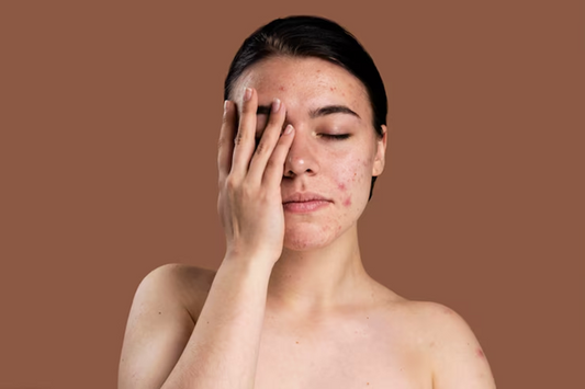 How to Soothe Acne-Prone Skin with Natural Ingredients